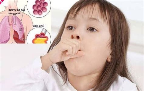 hình ảnh viêm phổi ở trẻ em